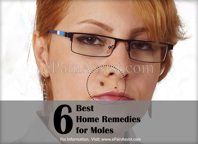 6 Best Home Remedies for Moles or Melanocytic Nevi