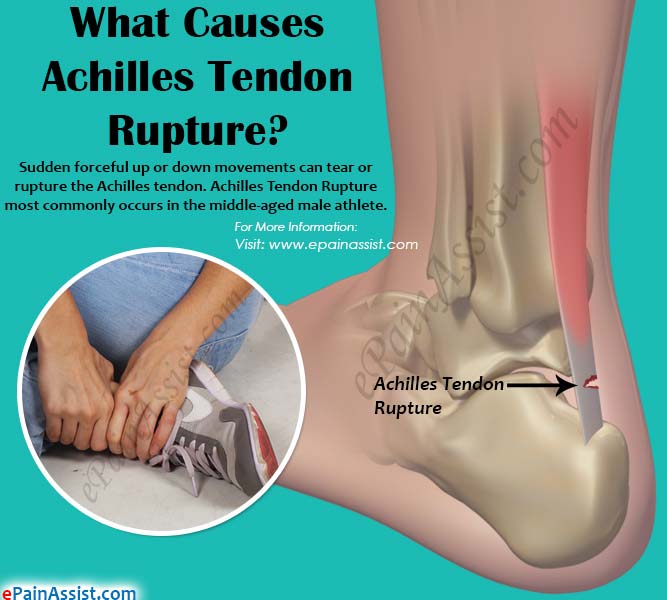 What Causes Achilles Tendon Rupture 