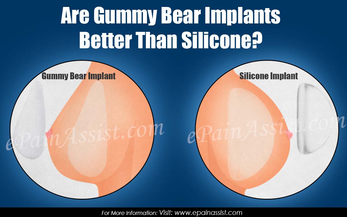 Gummy Bear Implants: Pros and Cons, Cost, Precautions