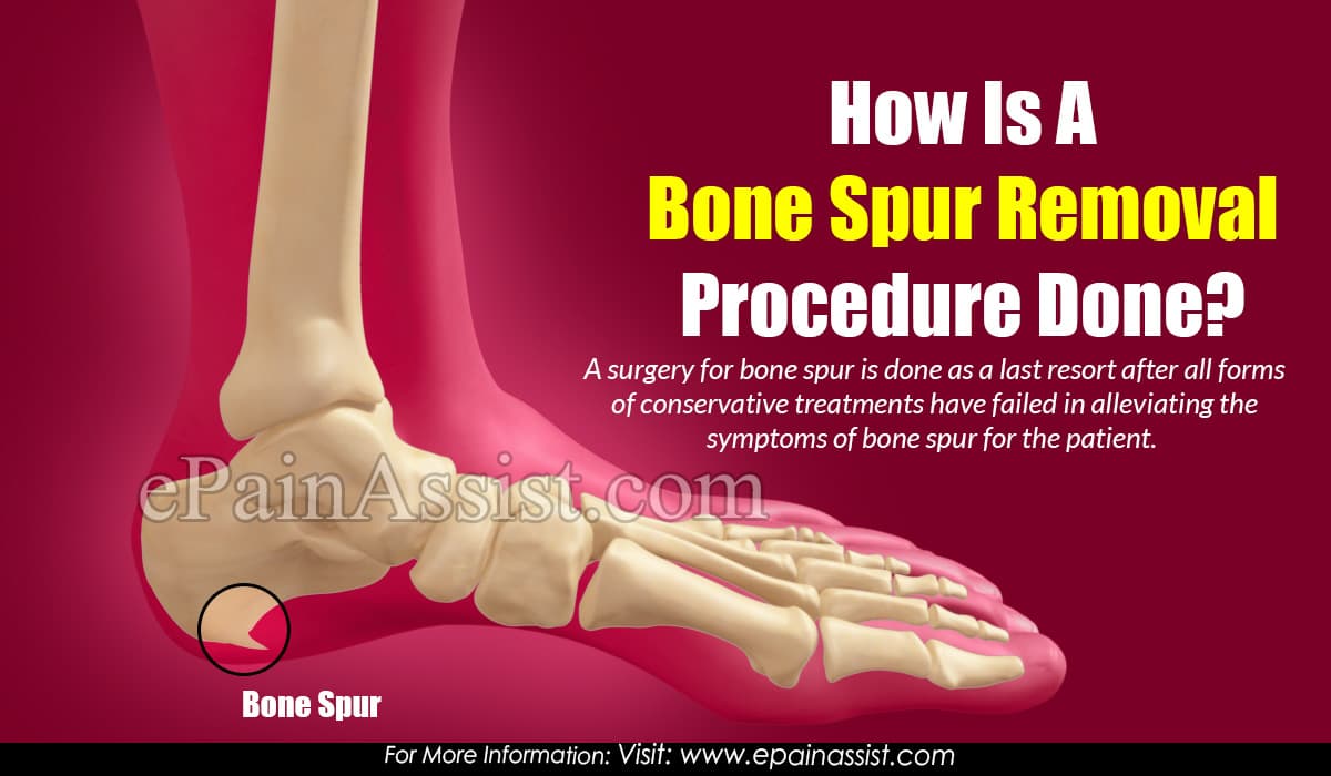 bone spur treatment without surgery