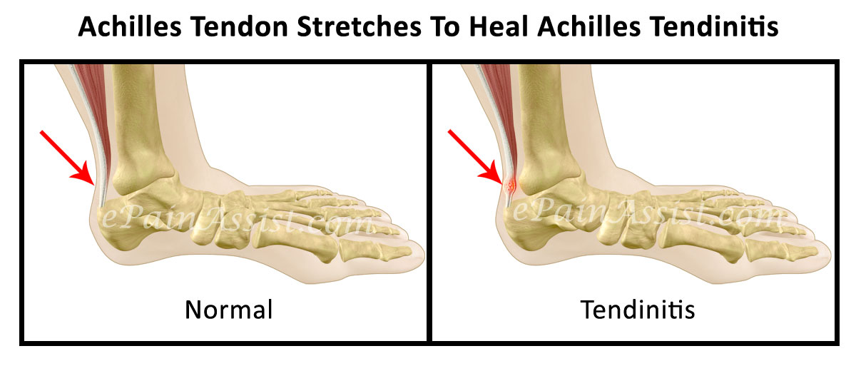 stretching achilles tendon