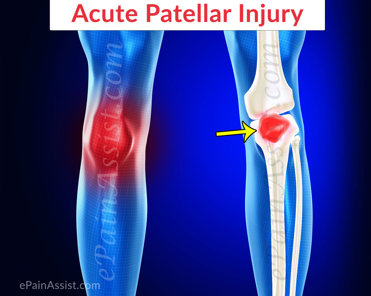 patella knee injury