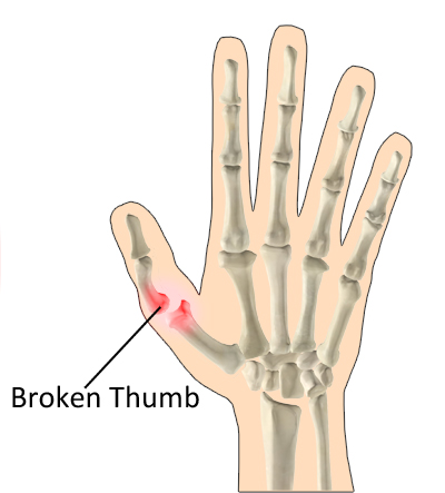 how can you tell if your thumb is broken