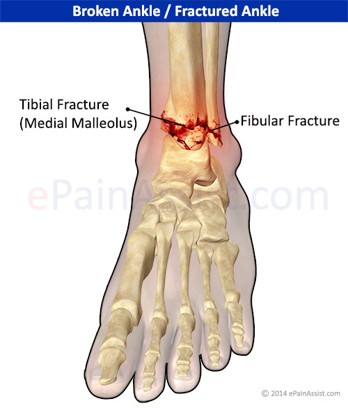 Ankle Joint Fracture|Types|Classification|Symptoms ...