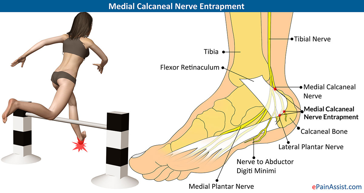 heel nerve entrapment