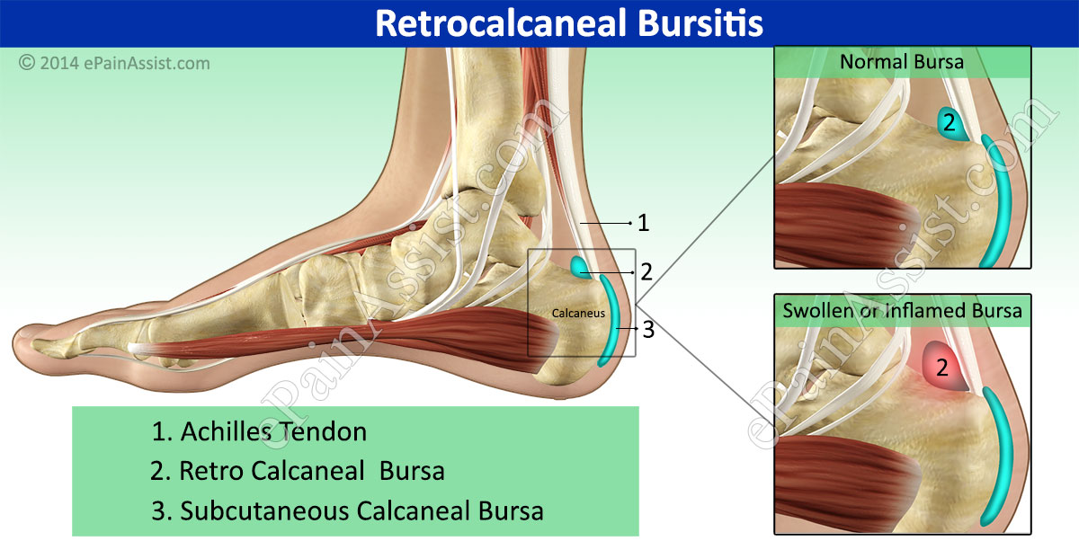 subcutaneous calcaneal bursa pain causes