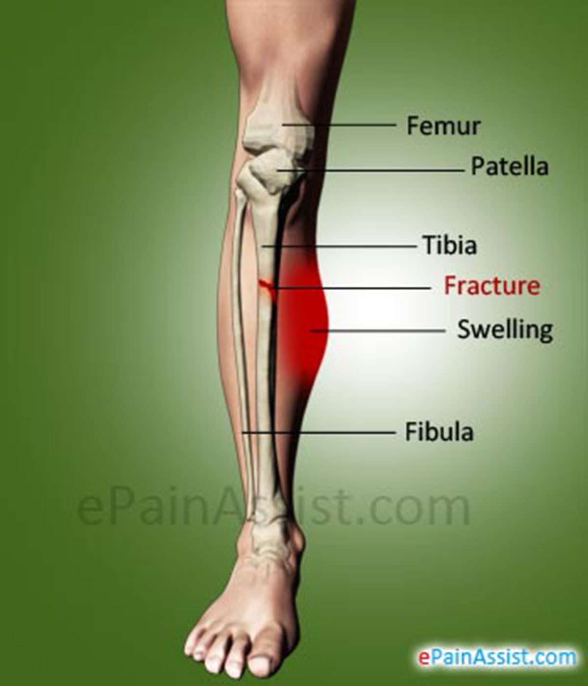 Shin Fracture or Fracture of TibiaCauses, Symptoms, Types
