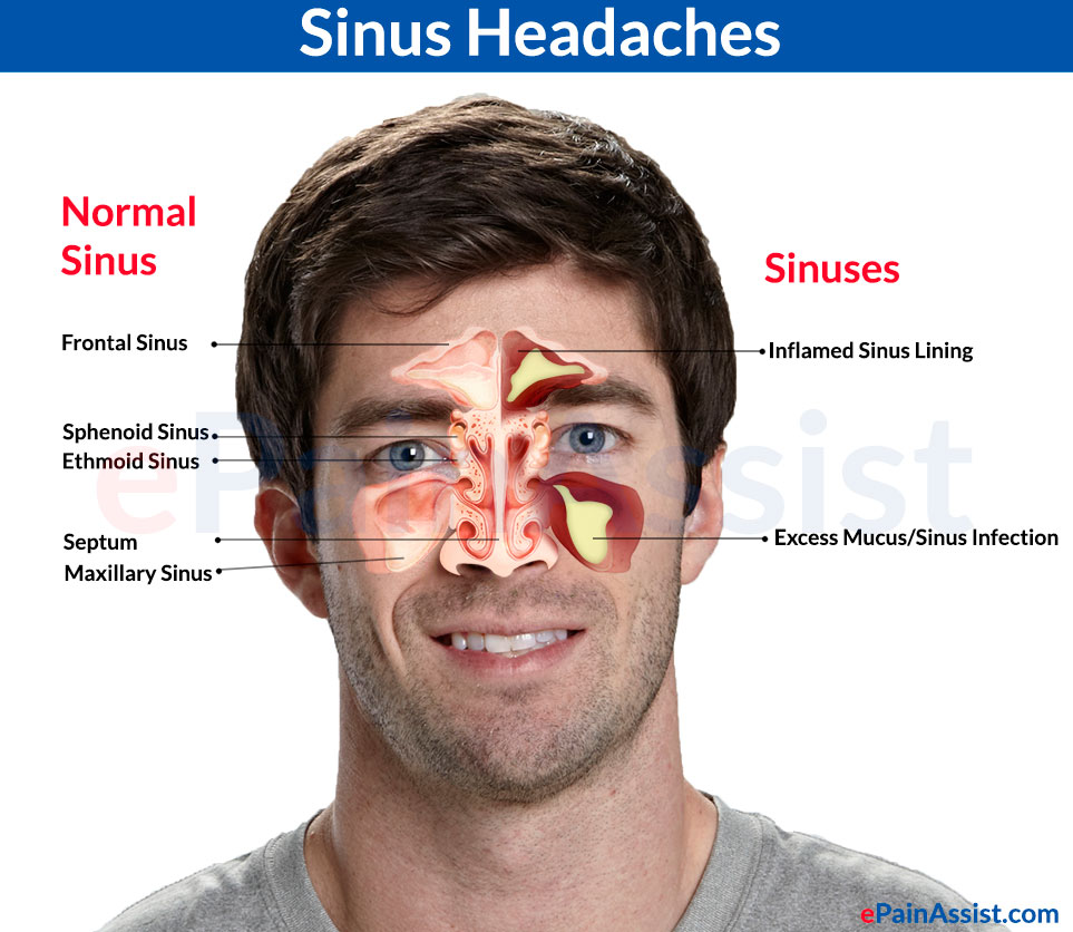 Sinus Headaches Treatment Prevention Differentiating It From Migraine
