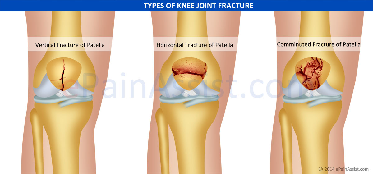 chipped kneecap symptoms