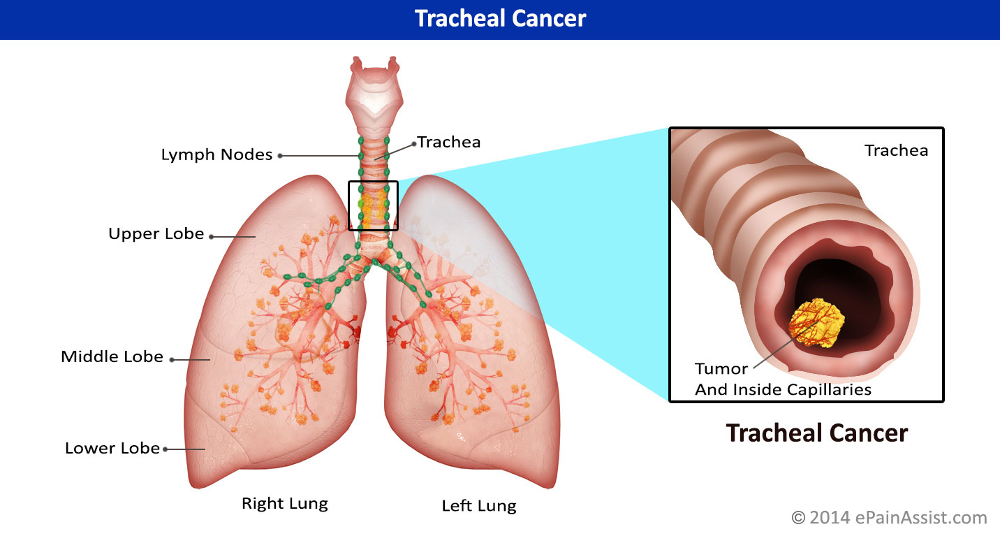 Tracheal Cancer Causes Signs Symptoms Stages Grading Treatment Surgery