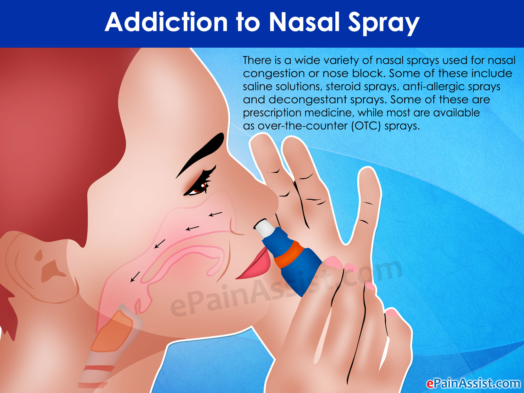 Addiction to Nasal Spray: Treatment 