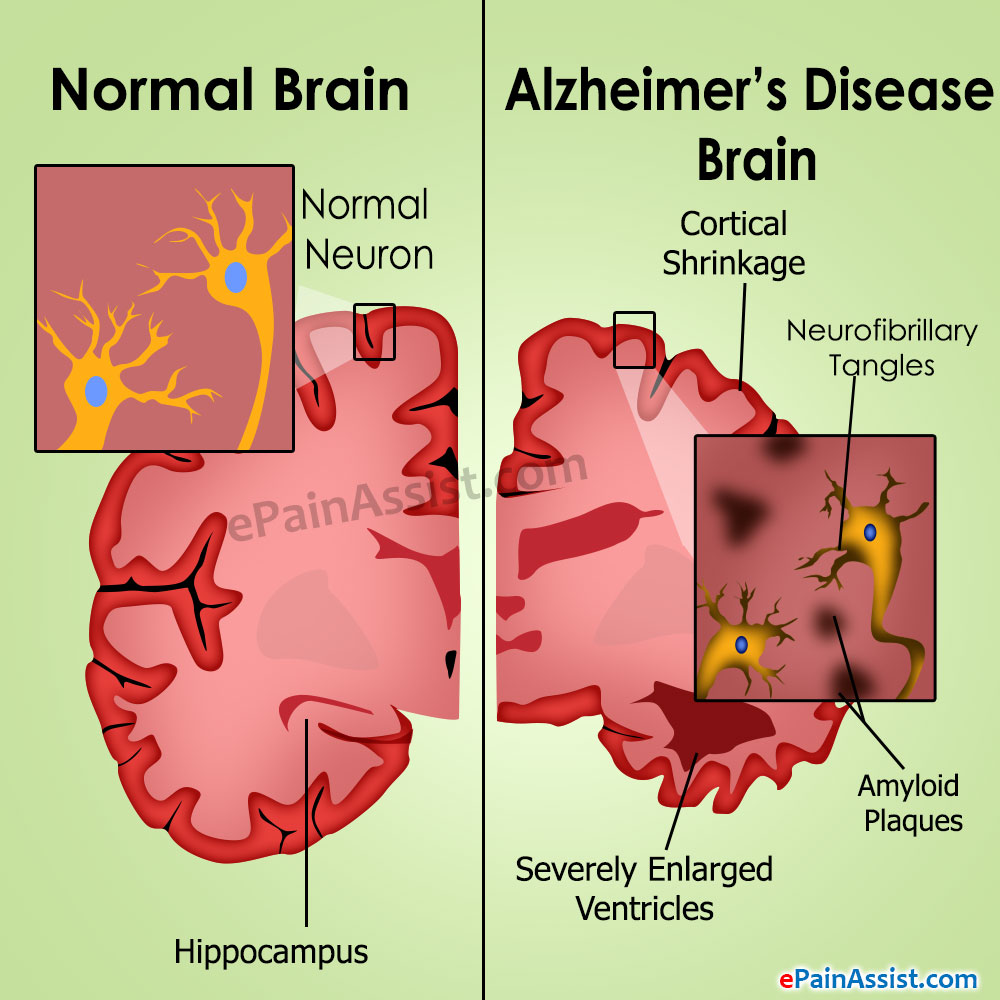 Alzheimer’s Disease CausesStagesTreatmentPrognosis