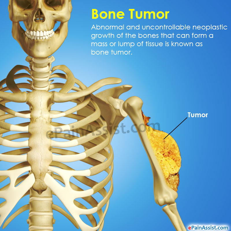 Signs Of Bone Cancer In Ribs - CancerWalls