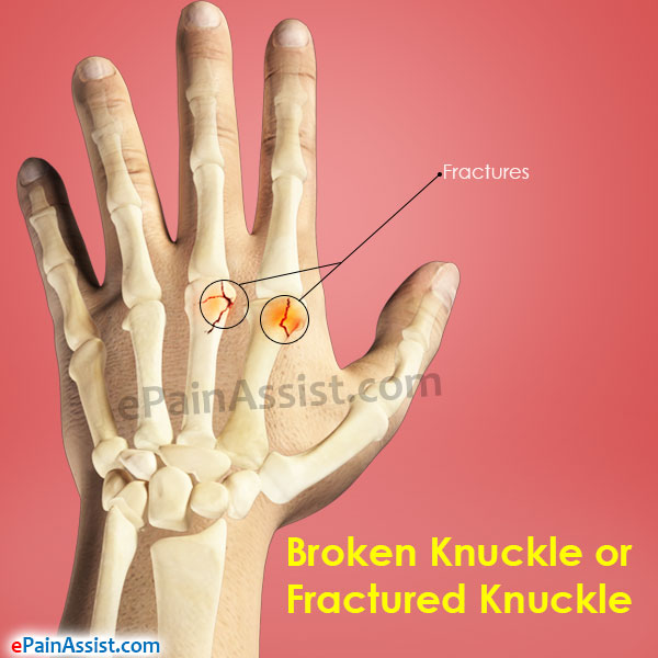 Broken Knuckle or Fractured Knuckle: Treatment and Symptoms