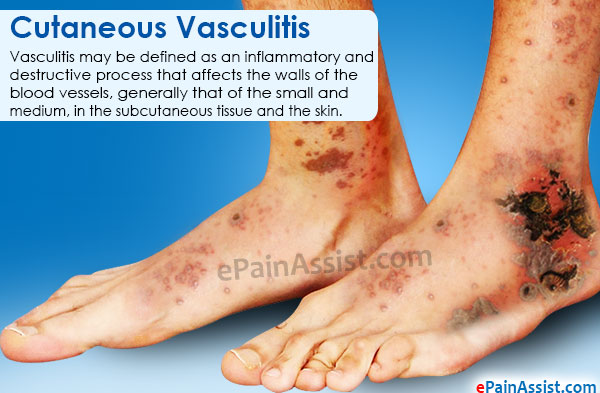 Cutaneous Vasculitis|Causes|Signs|Symptoms|Treatment|Prognosis|Epidemiolgy
