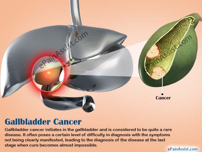 Gallbladder Cancer|Survival Rate|Stages|Prognosis|Treatment|Causes|Symptoms