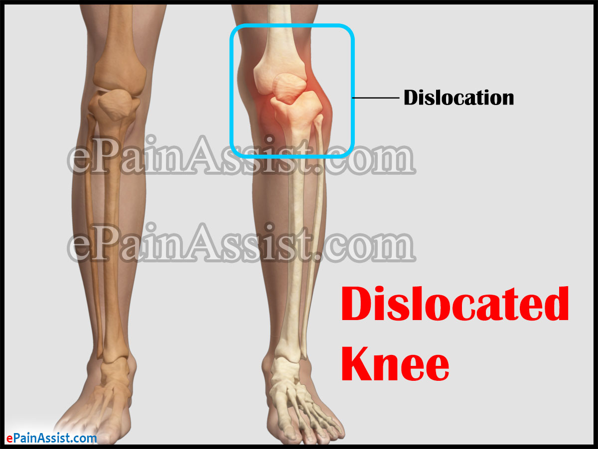 relocating a dislocated knee