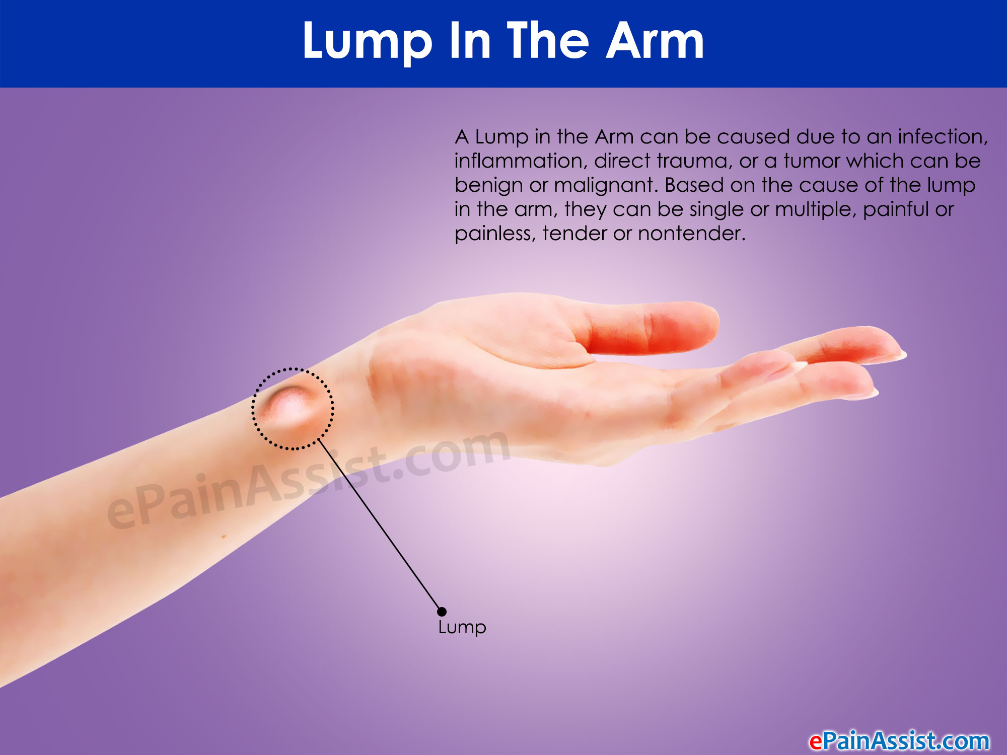 What can cause a lump in the arm and how is it treated or removed?