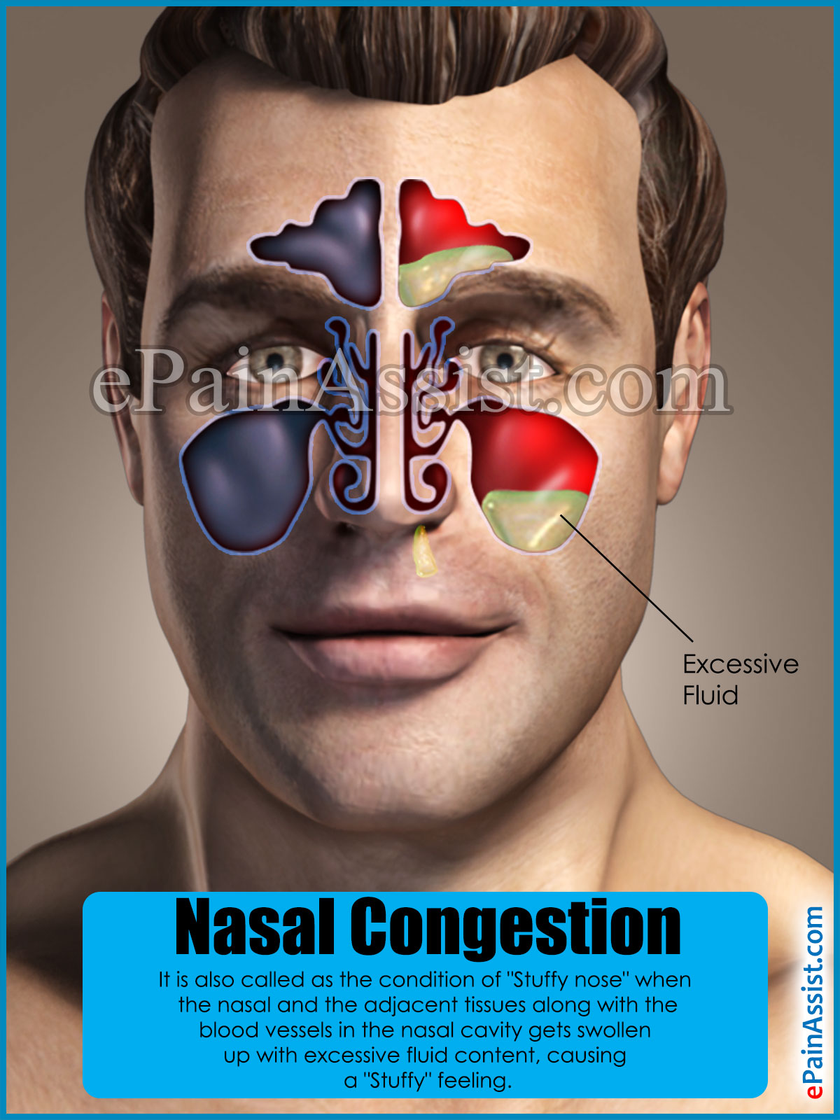 what's nasal congestion