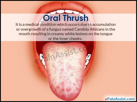 Oral Thrush: Causes, Treatment, Home Remedies, Prevention