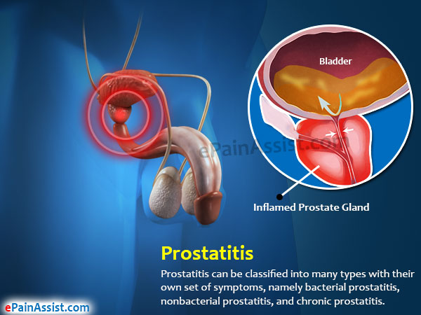 Prostatitis Treatment Types Diet Causes Symptoms Diagnosis