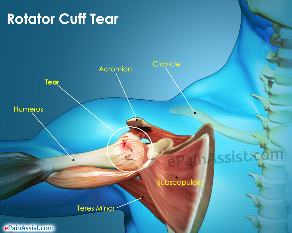 symptoms of rotator cuff damage