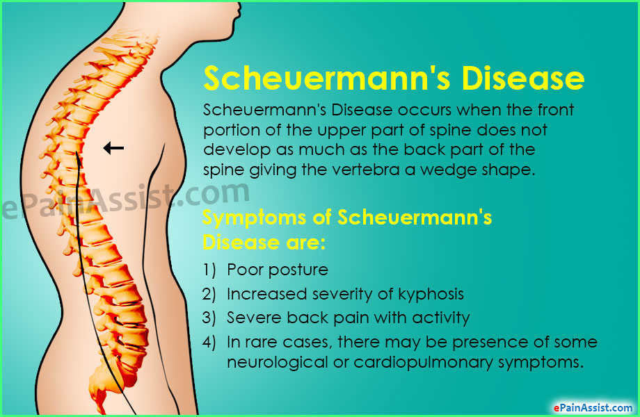 Scheuermann's Disease or Scheuermann's Kyphosis|Causes|Symptoms