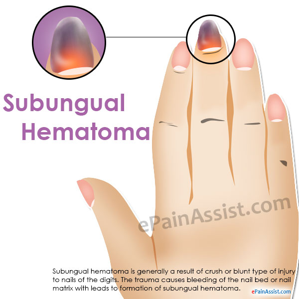Subungual Hematoma Causes Symptoms Treatment Investigations Neurovascular