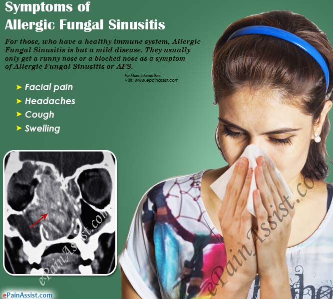 Allergic Fungal Sinusitis|Causes|Symptoms|Treatment ...
