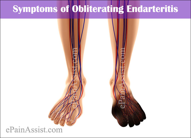 Symptoms of Obliterating Endarteritis