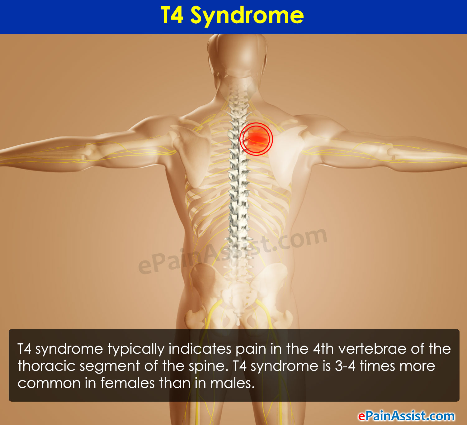 T4 Syndrome