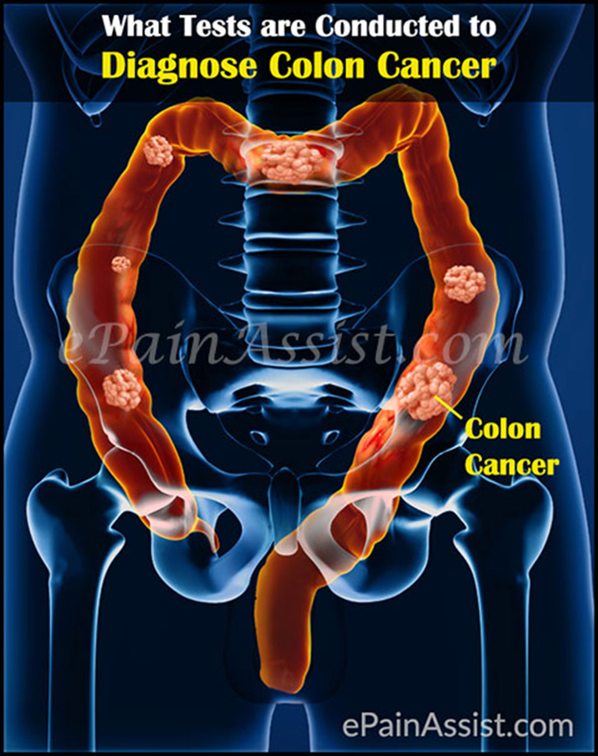 Diagnosis, Stages, Treatment of Colon Cancer or Cancer of the Colon