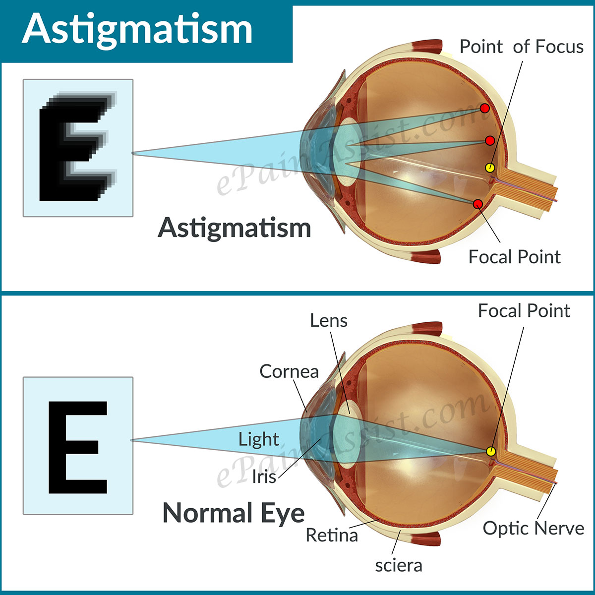 how to correct astigmatism        <h3 class=