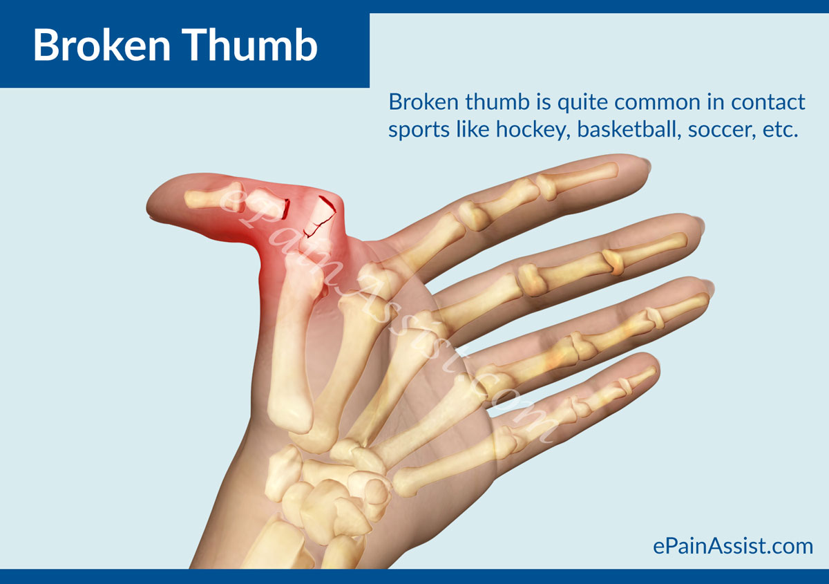 Broken Thumb: Treatment, Exercises, Causes, Symptoms, Risk Factors