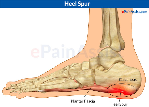 heel spurs symptoms and treatment