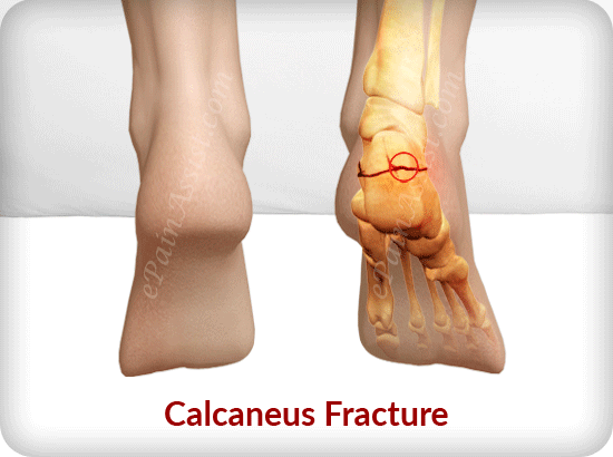 heel fracture pain
