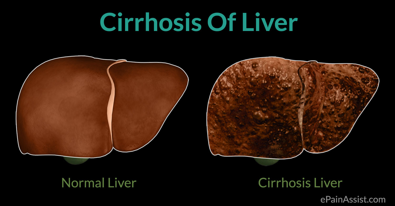 latest medicine research for liver cirrhosis