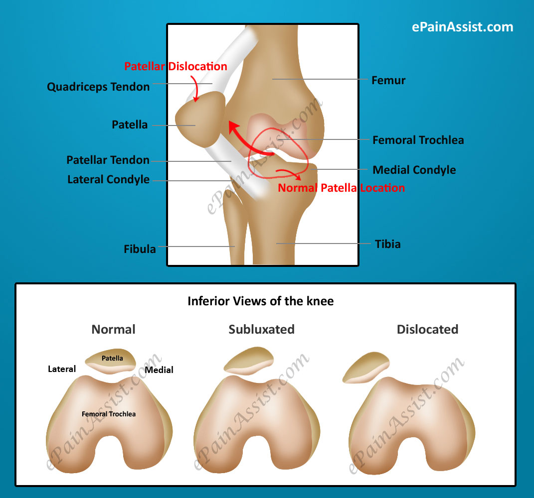 signs of knee dislocation