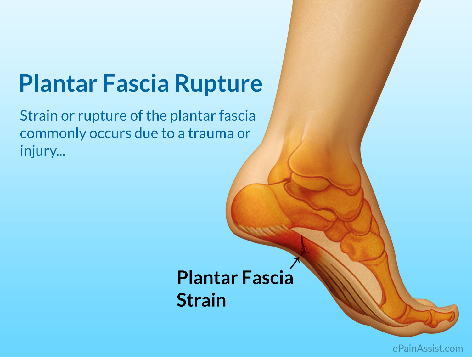 fascia tear in foot