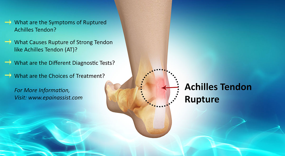 remedy for achilles heel