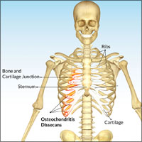 injured rib cartilage