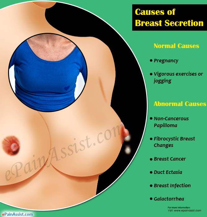 Causes of Breast Secretion or Nipple Discharge & its Treatment, Prognosis,  Complications