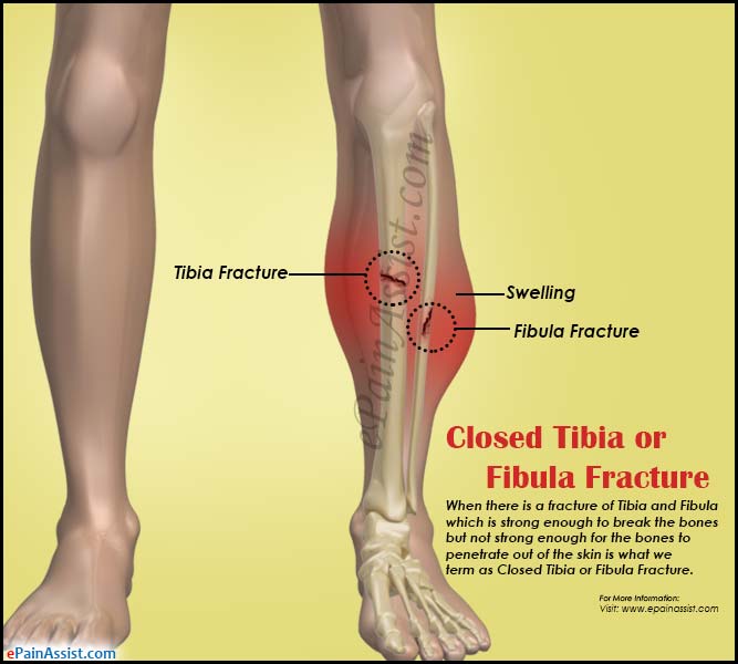 spiral fracture of tibia and fibula recovery time