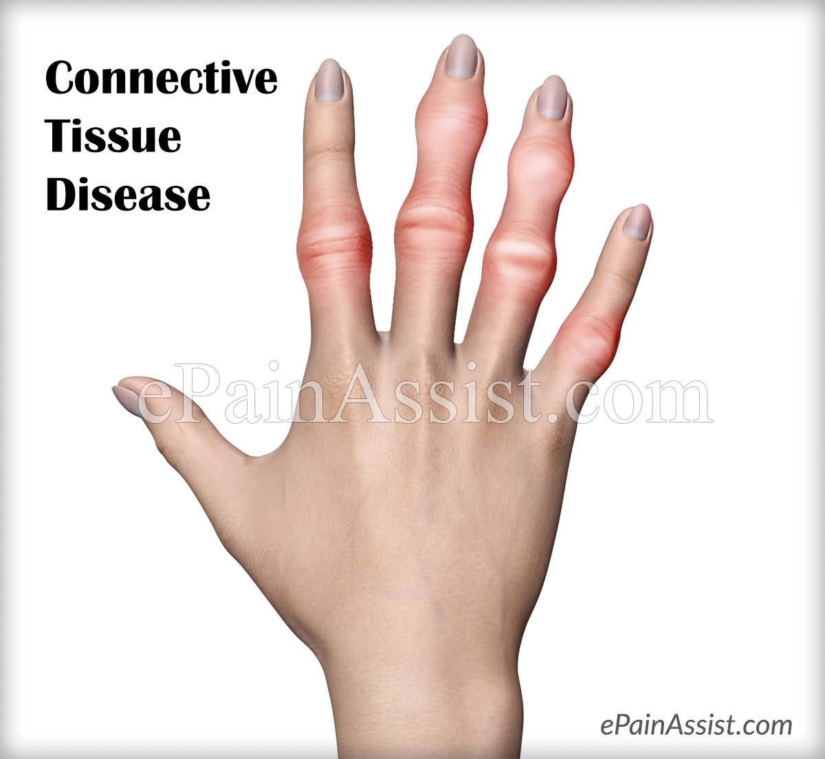 Lupus And Inexplicable Connective Tissue Inflammation
