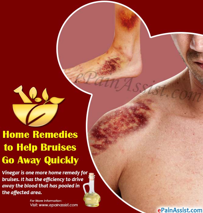 Home Remedies To Help Bruises Go Away Quickly