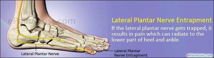lateral plantar nerve entrapment