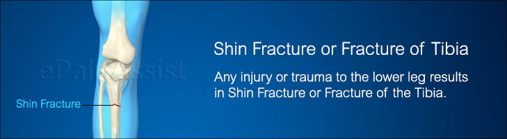 hairline fracture in shin