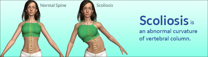 Scoliosisclassificationtypescausessymptomssignstreatmentbrace