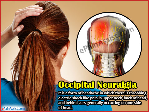 Occipital Neuralgia Treatment Symptoms Causes Diagnosis