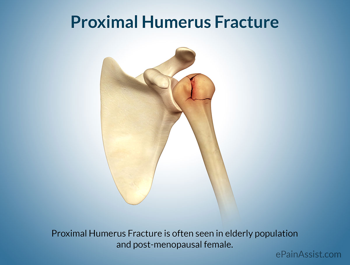 What is a proximal shaft humerus fracture?